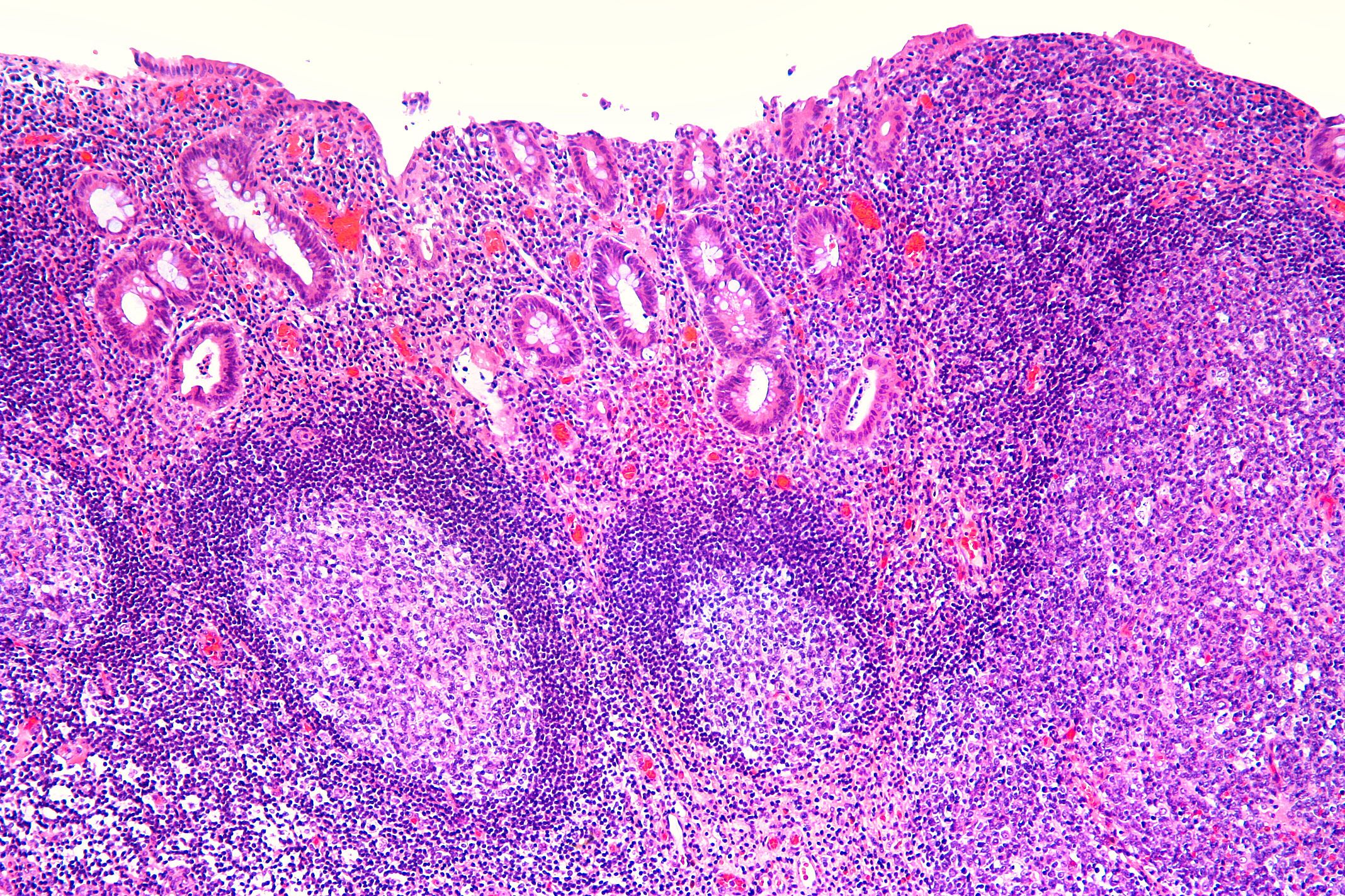 Diversionskolitis
Kolonschleimhaut mit lymphoplasmazellulären Infiltraten sowie lymphofollikulärer Hyperplasie
